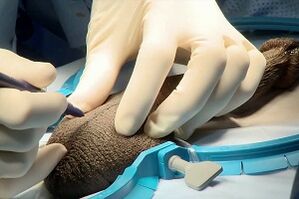 Midge cut for surgical penis expansion