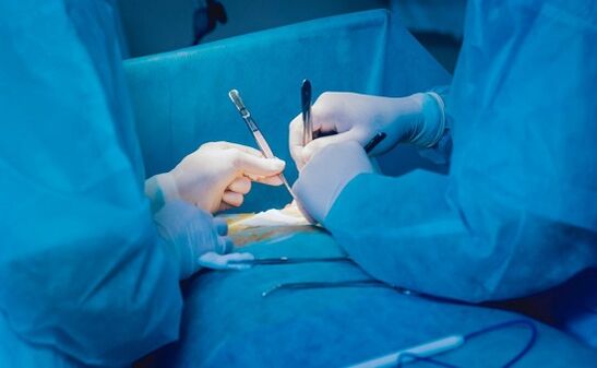 Performing the penis expansion operation